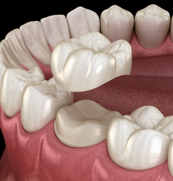 Illustrated dental crown being fitted over a tooth