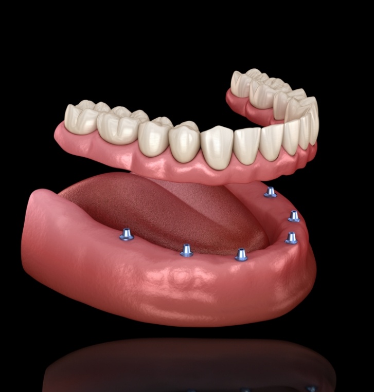 Illustrated implant denture in Hillsboro replacing a full arch of missing teeth
