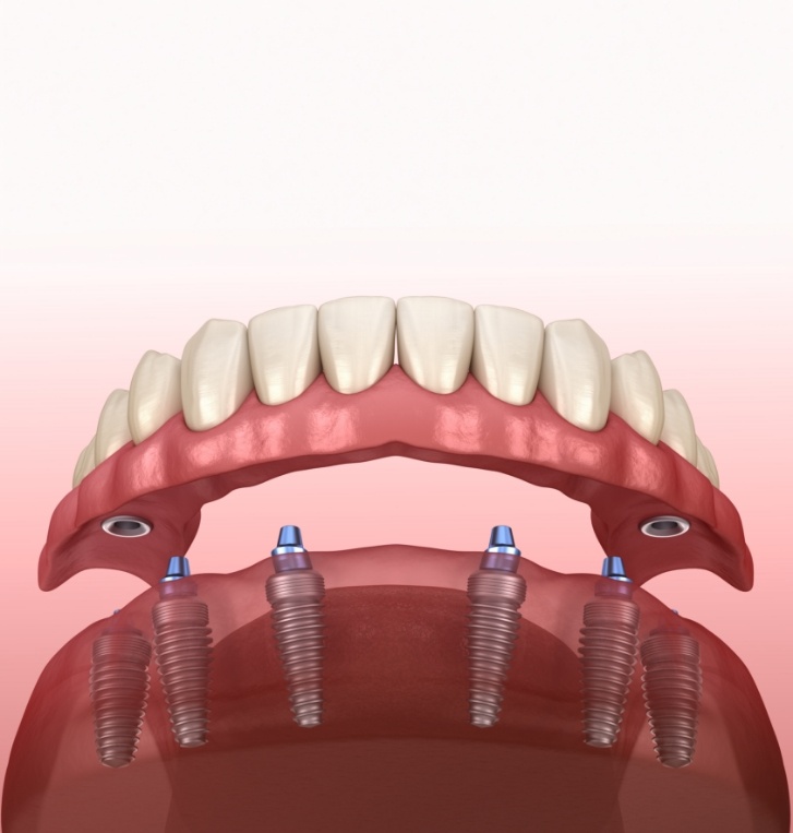 Illustration of implant dentures being placed in lower jaw