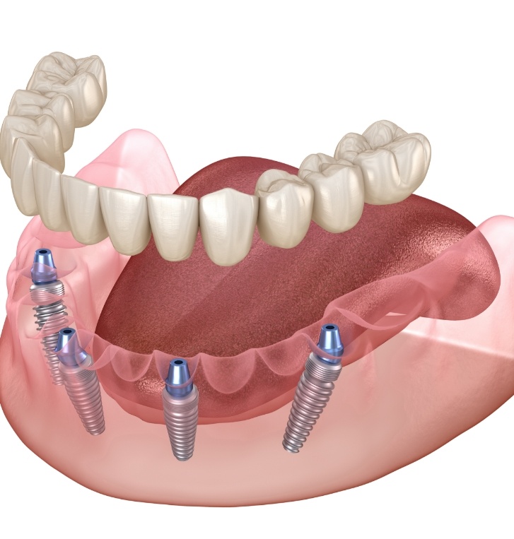 Illustration showing All-on-4 dental implants in Hillsboro for top and bottom arches