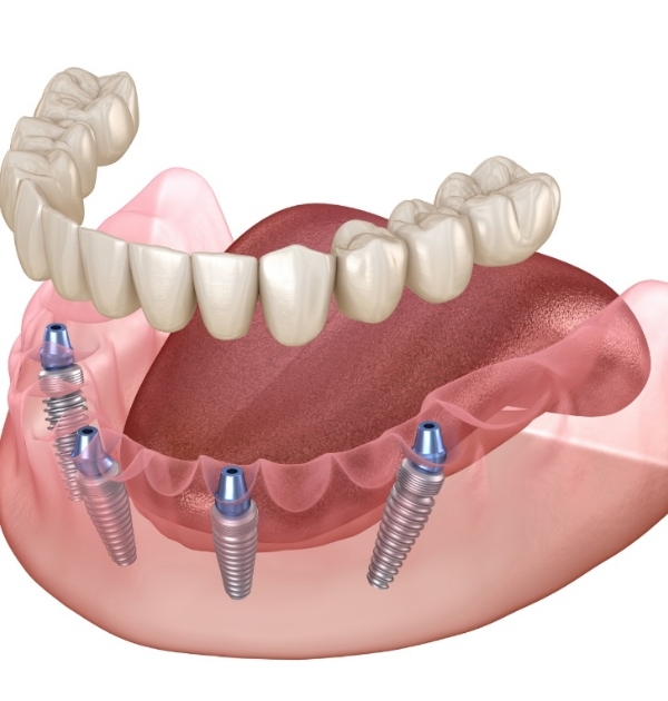 Illustrated model of All on X implant denture in Hillsboro