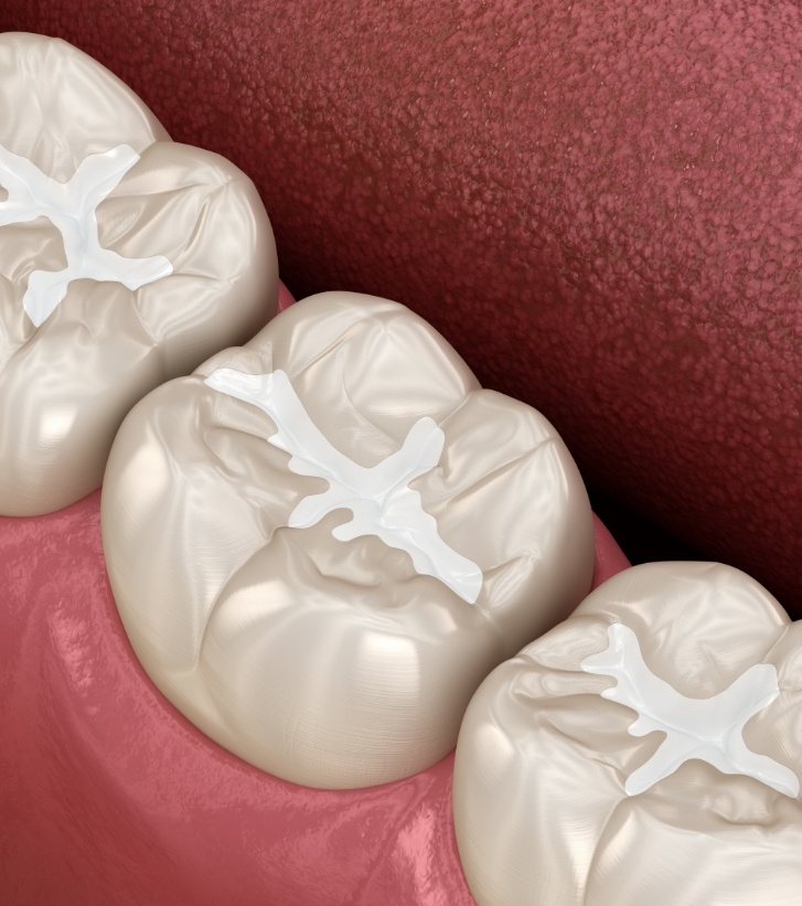 Illustrated row of teeth with dental sealants