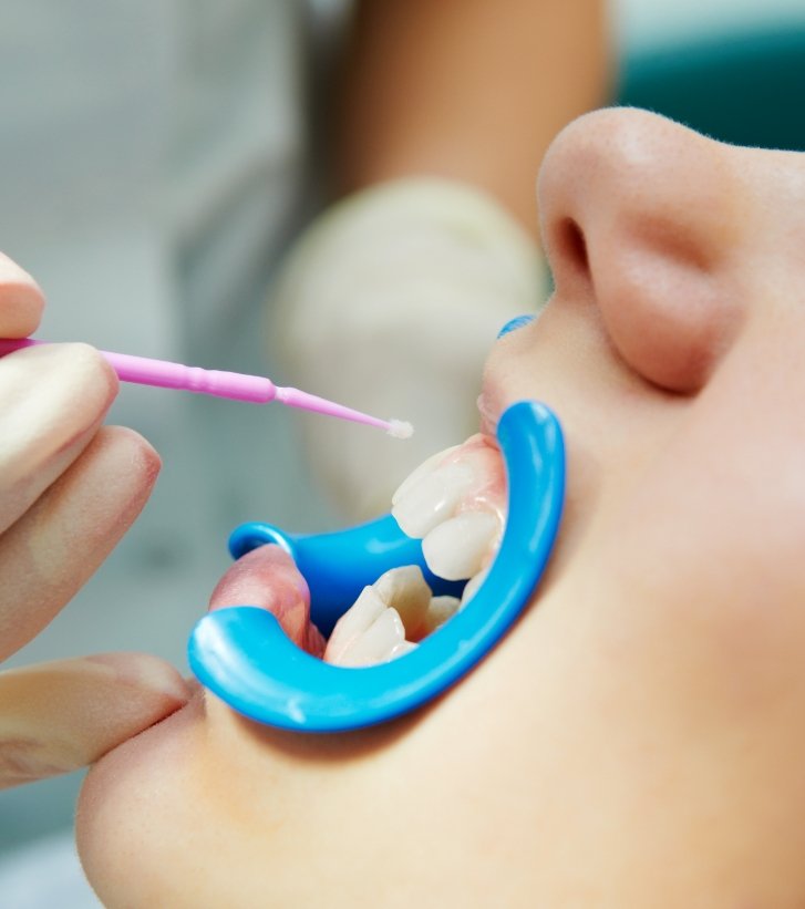 Close up of child dental patient getting fluoride applied to their teeth