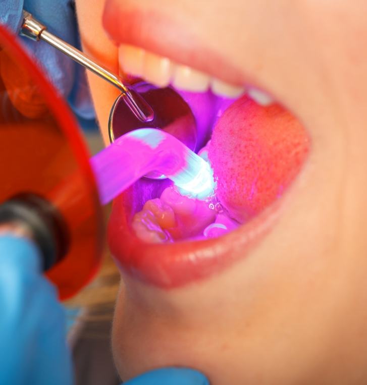 Close up of dental patient getting cosmetic dental bonding