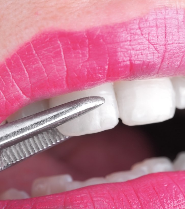 Close up of dental veneer being placed on a tooth