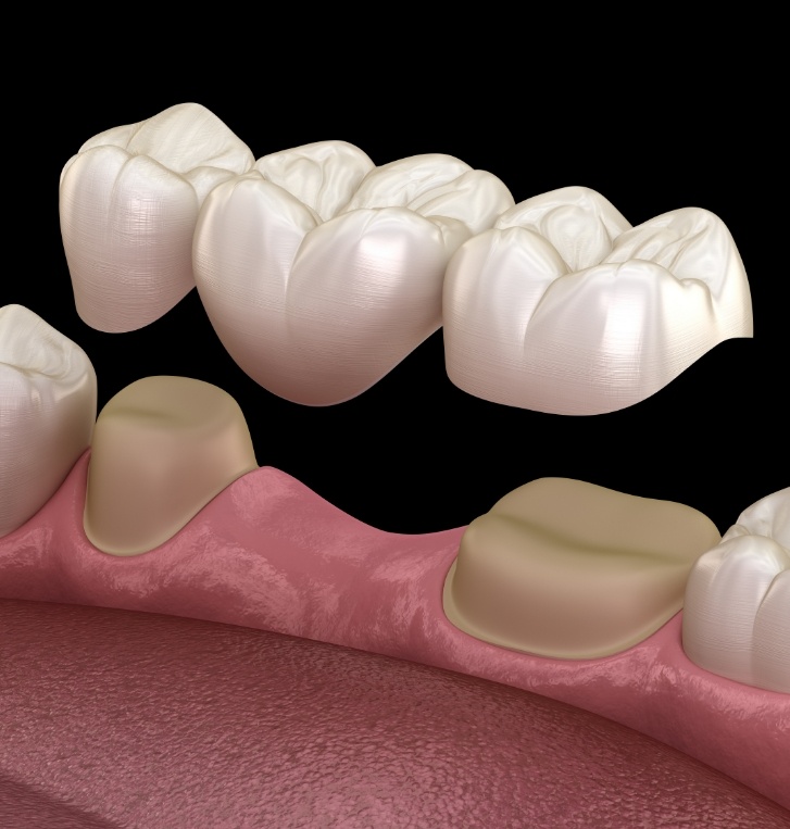 Illustrated dental bridge in Hillsboro replacing a missing tooth