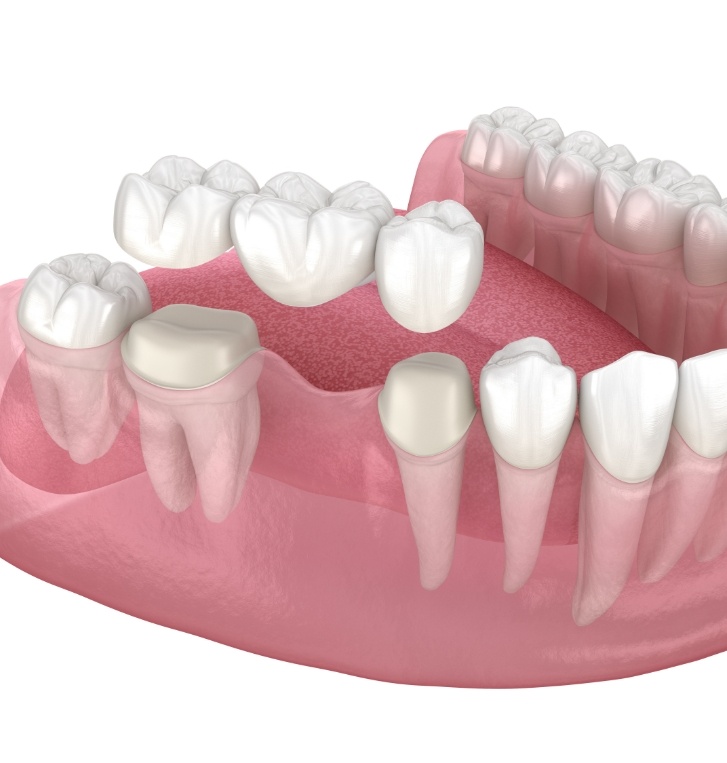 Traditional dental bridge replacing a missing tooth