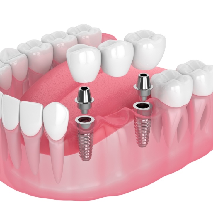 Illustrated dental bridge being placed onto two dental implants