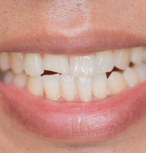Close up of person pointing to their chipped tooth before dental crowns in Hillsboro