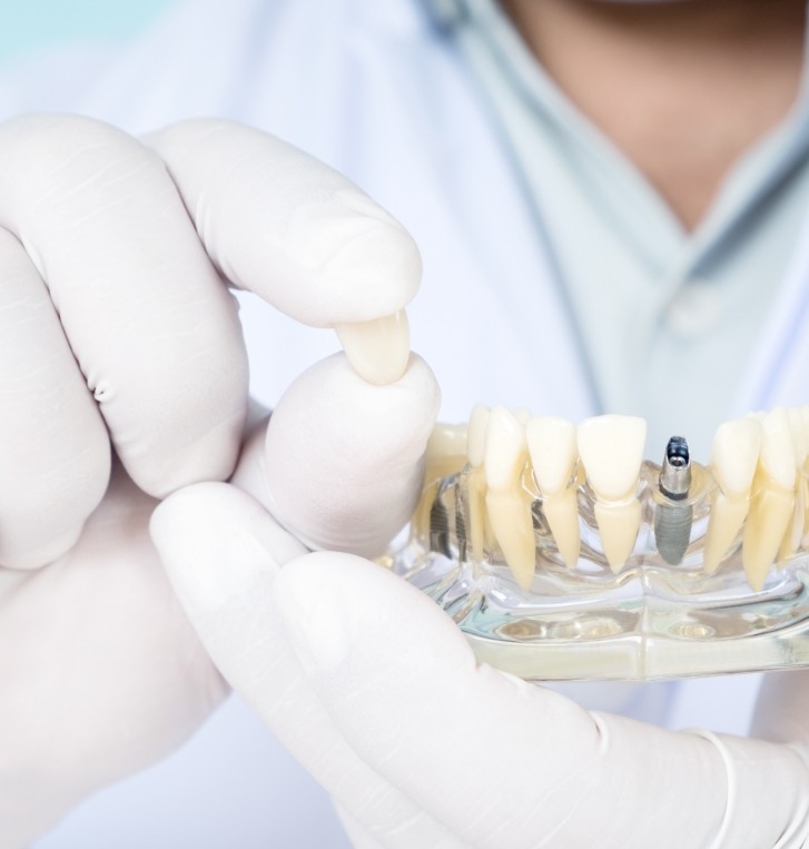 Dentist holding a dental crown and a model of dental implants in Hillsboro