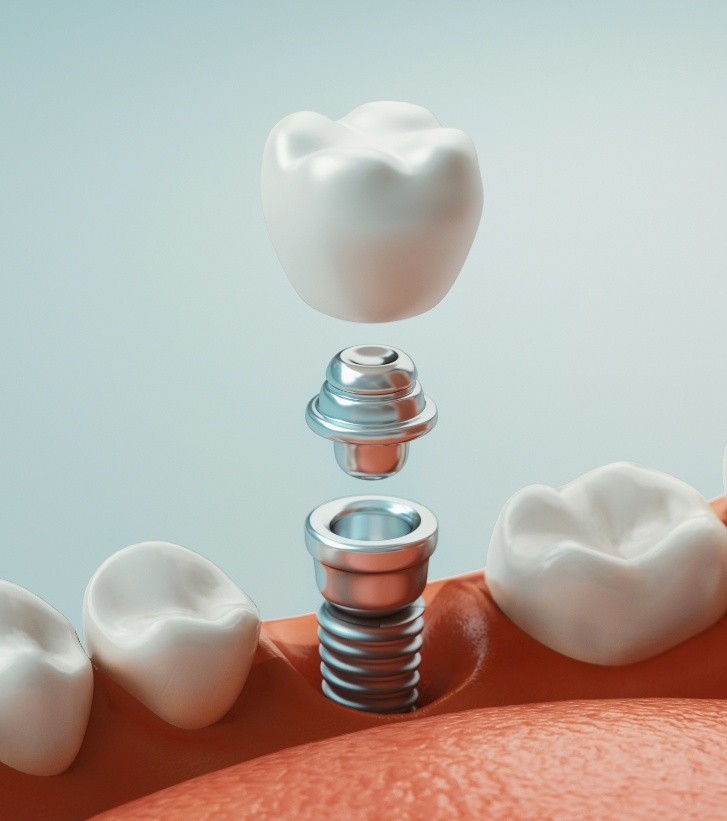 Illustrated dental implant with crown and abutment