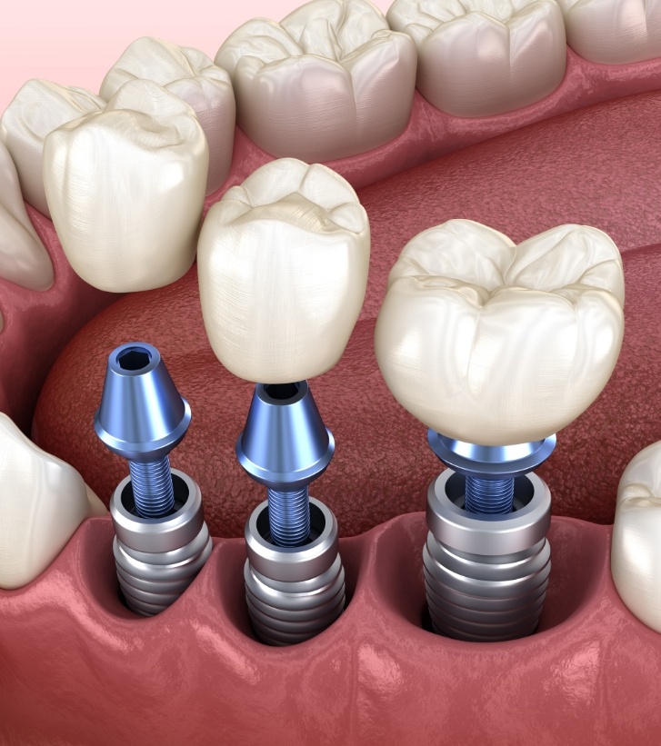 Illustration of three dental crowns being placed onto three dental implants