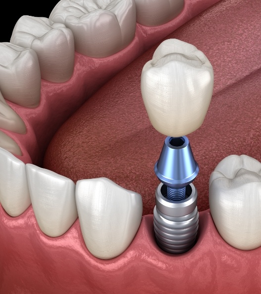 dental bridge attached to two dental implants