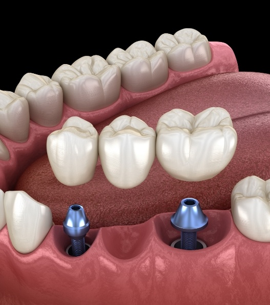 full denture attached to six dental implants