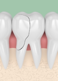 Illustrated cracked tooth