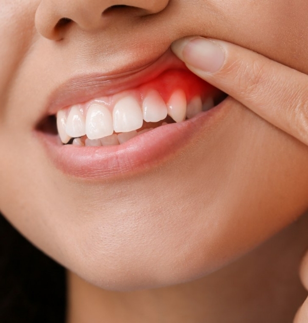 Person pointing to their red gums before gum disease treatment in Hillsboro