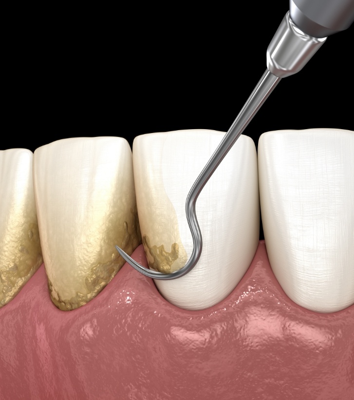 Illustrated dental instrument clearing plaque buildup from teeth