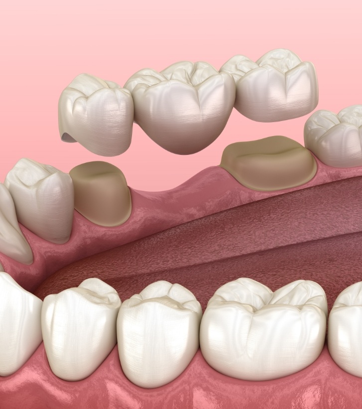 Illustration of dental bridge replacing a missing tooth