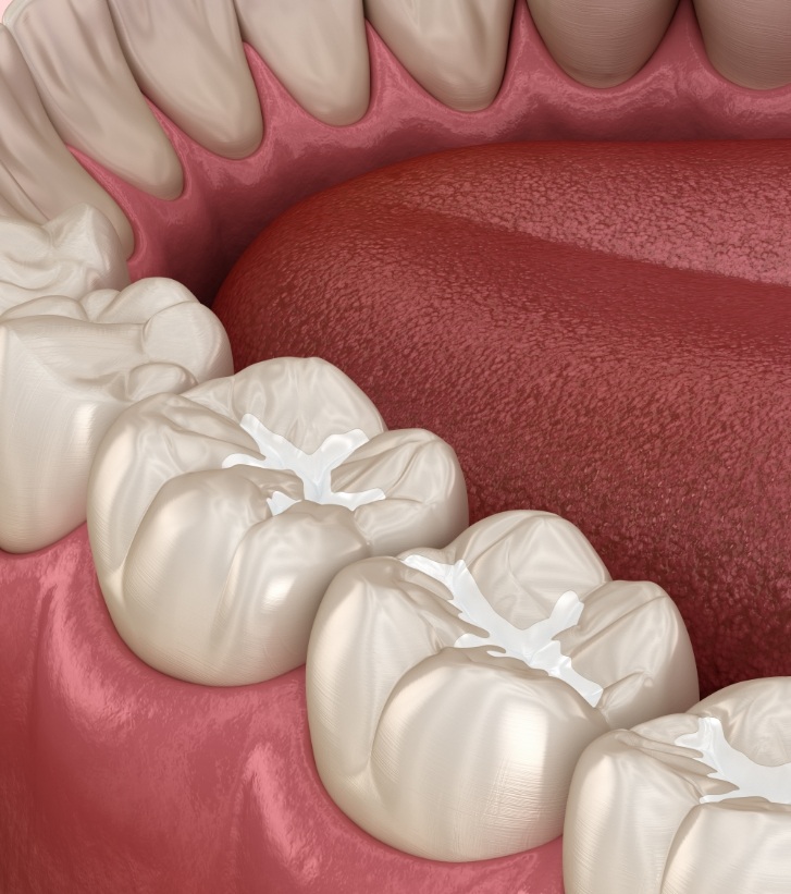 Illustrated row of teeth with white fillings