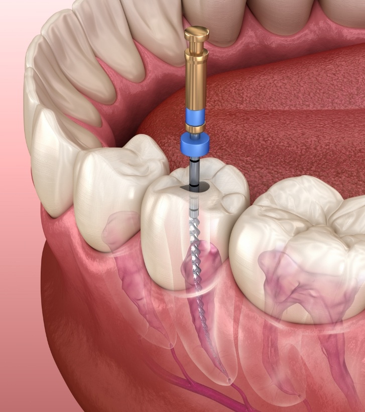 Illustrated dental instrument cleaning inside of tooth during root canal treatment