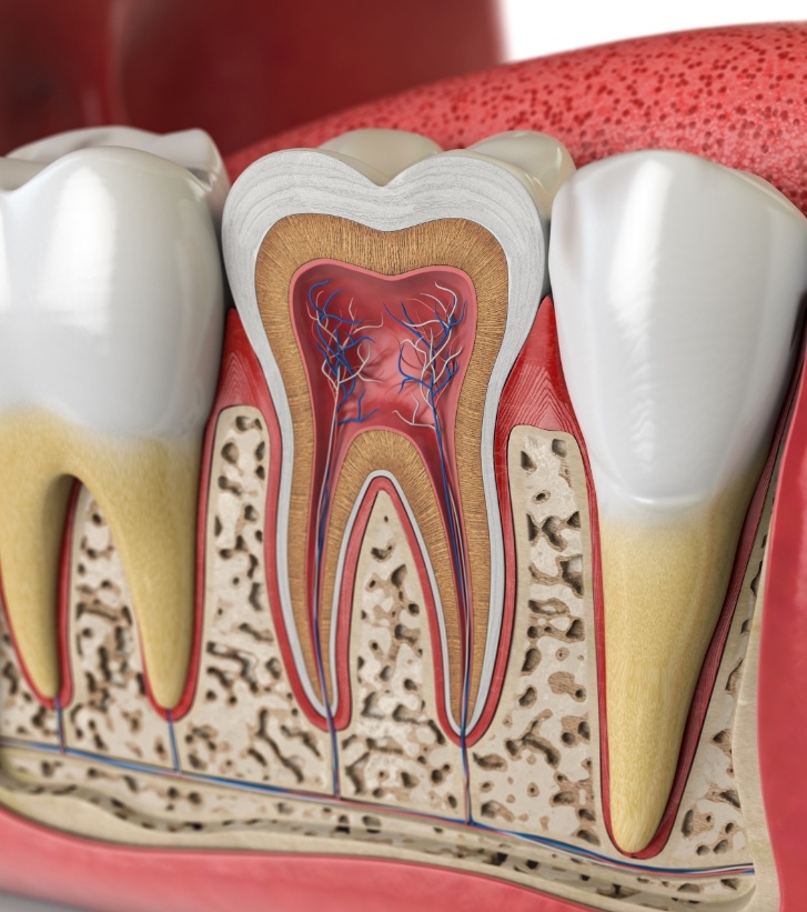 Illustrated tooth in need of root canal