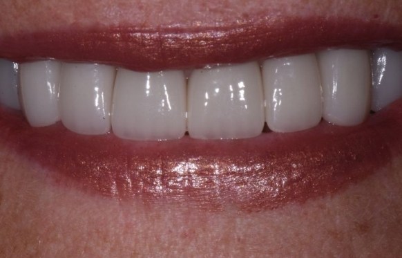 Close up of flawless smile after treatment from Hillsboro cosmetic dentist