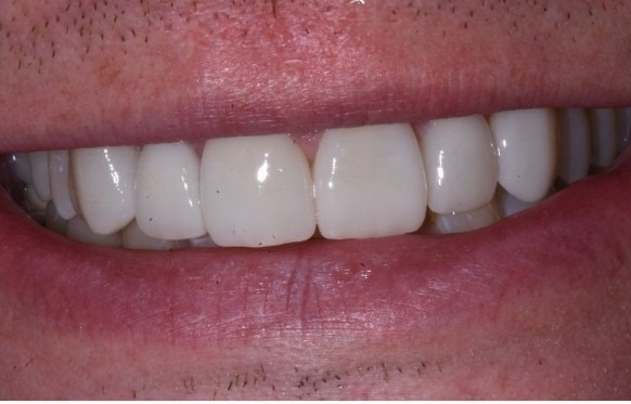 Close up of smile with whiter teeth