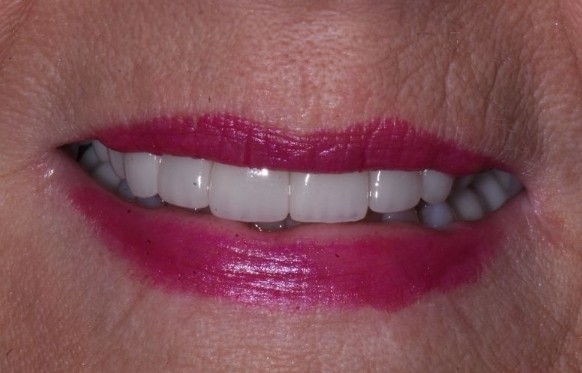 Close up of smile after teeth whitening