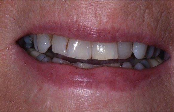 Close up of smile with slightly misaligned and chipped teeth