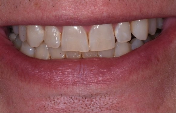 Close up of smile with slightly yellowed teeth