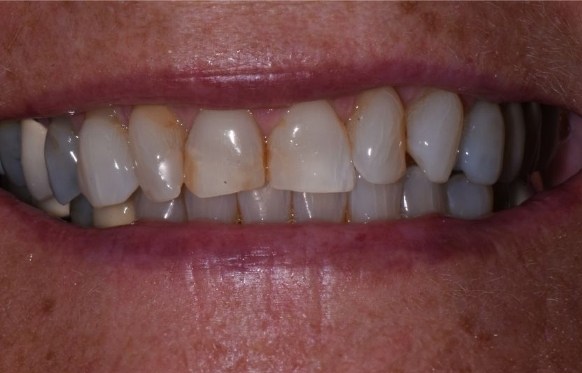 Close up of smile with discolored teeth