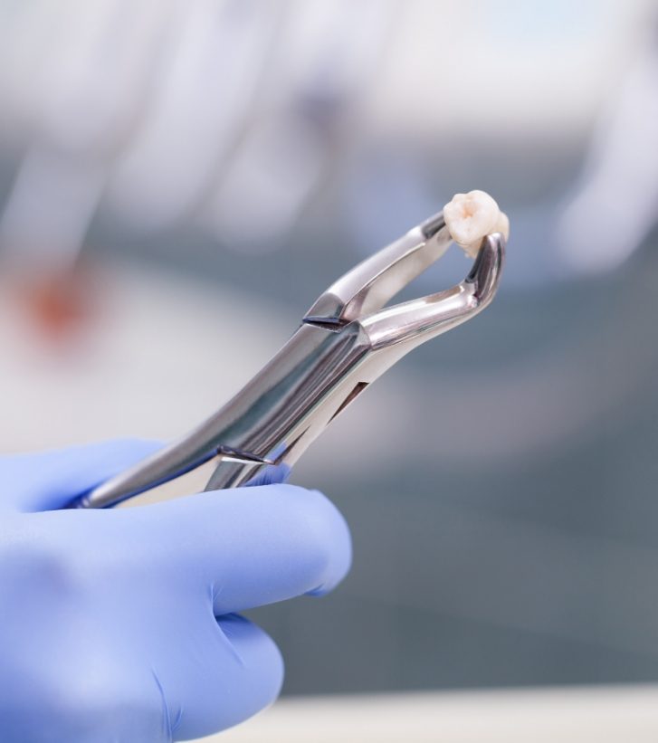 Dental forceps holding an extracted tooth