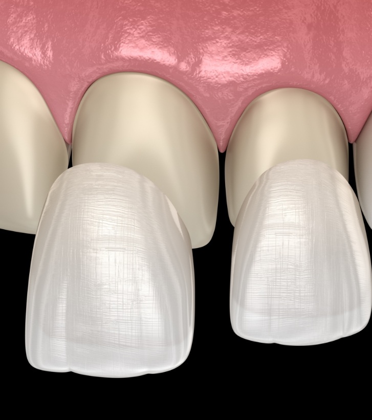 Two illustrated of veneers being placed over teeth