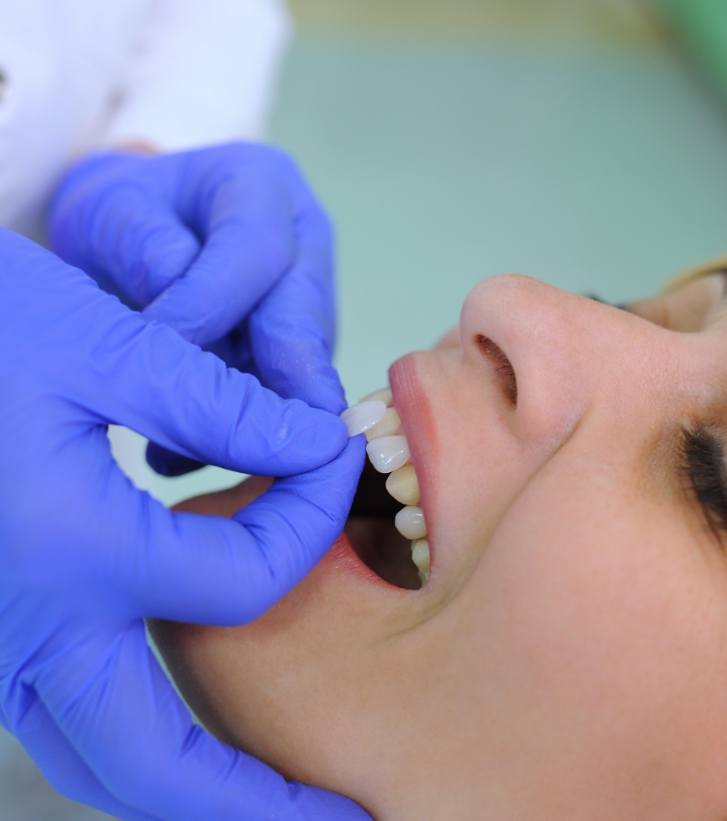 Dentist placing a veneer on a patients tooth