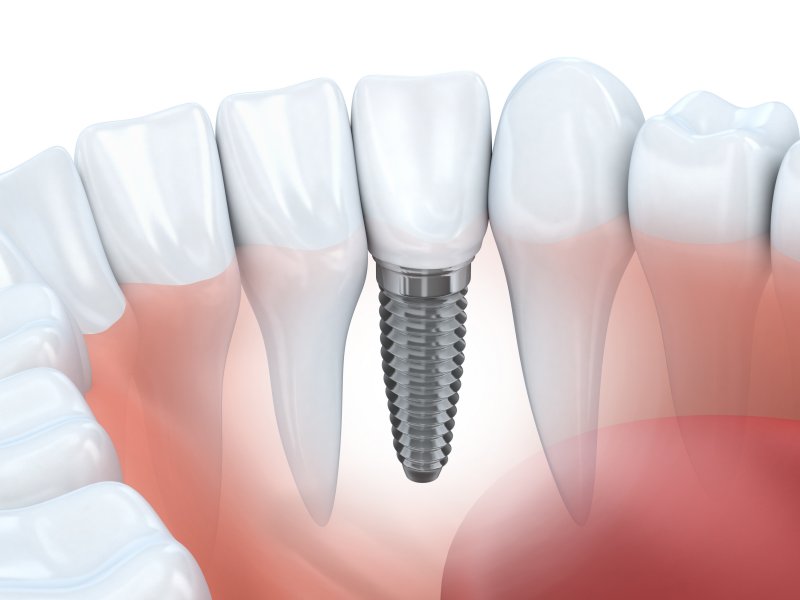 Diagram of a dental implant in Hillsboro