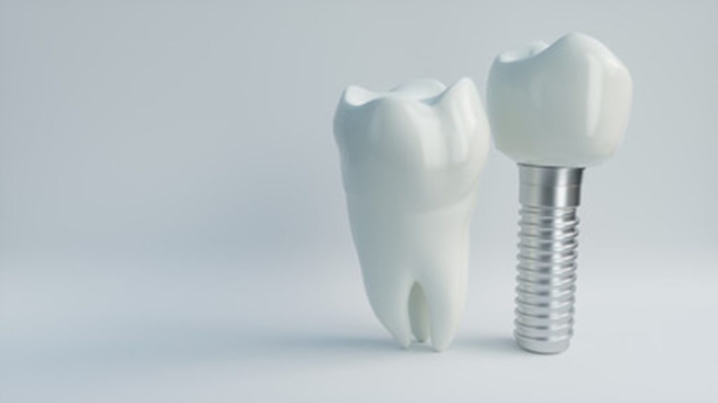 Model of dental implants.