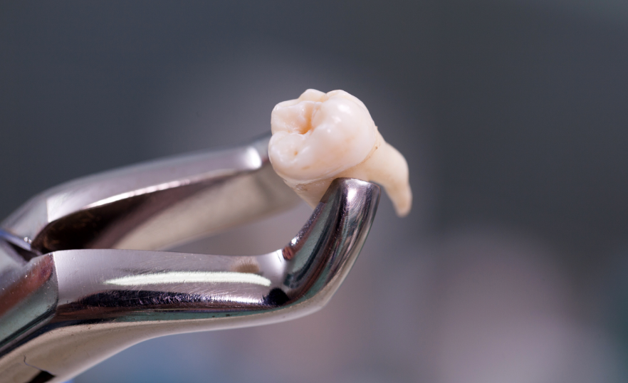 Extracted tooth