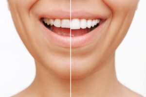 Nose-to-neck view of woman with short teeth that are half treated to show before/after results